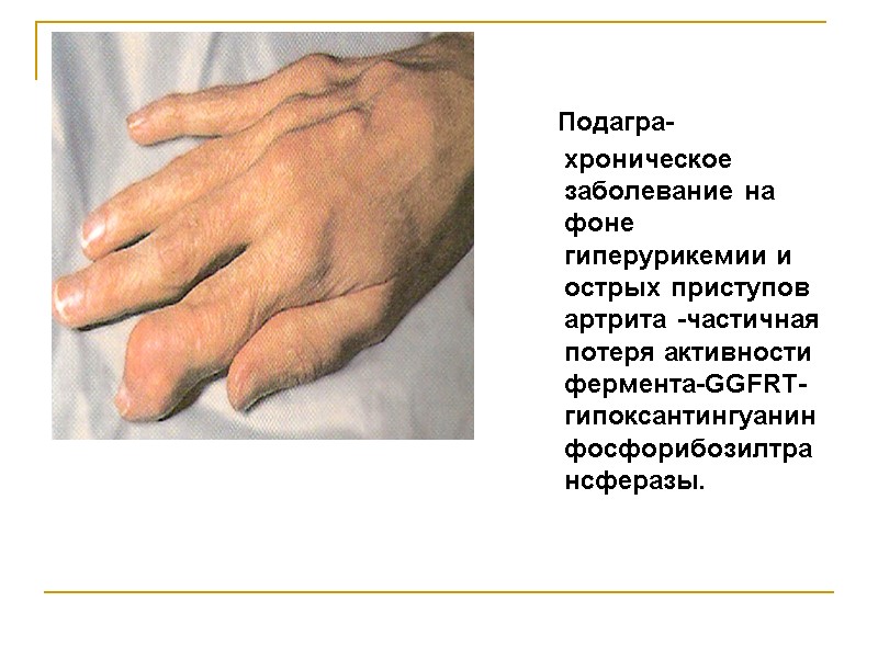 Подагра-хроническое заболевание на фоне  гиперурикемии и острых приступов артрита -частичная потеря активности фермента-GGFRT-гипоксантингуанинфосфорибозилтрансферазы.
